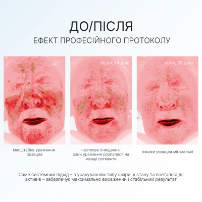 AG Skin Крем–гель з азелаїновою та саліциловою кислотами Rosy Cream gel, 50 мл