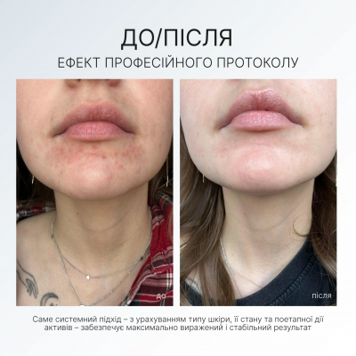 AG Skin Балансуючий крем-гель при розацеа REDNESS BALANCE CREAM GEL, 50 мл